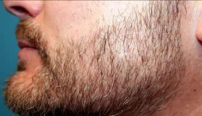 Beard Hair Transplants