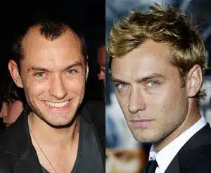 celebrity hair transplants