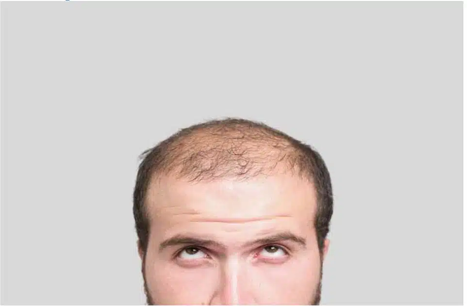 male baldness