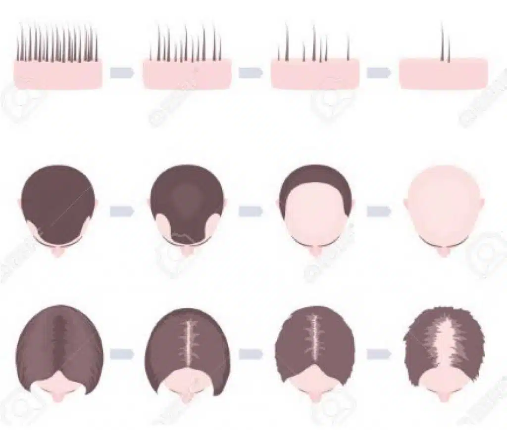 what does baldness patterns look like