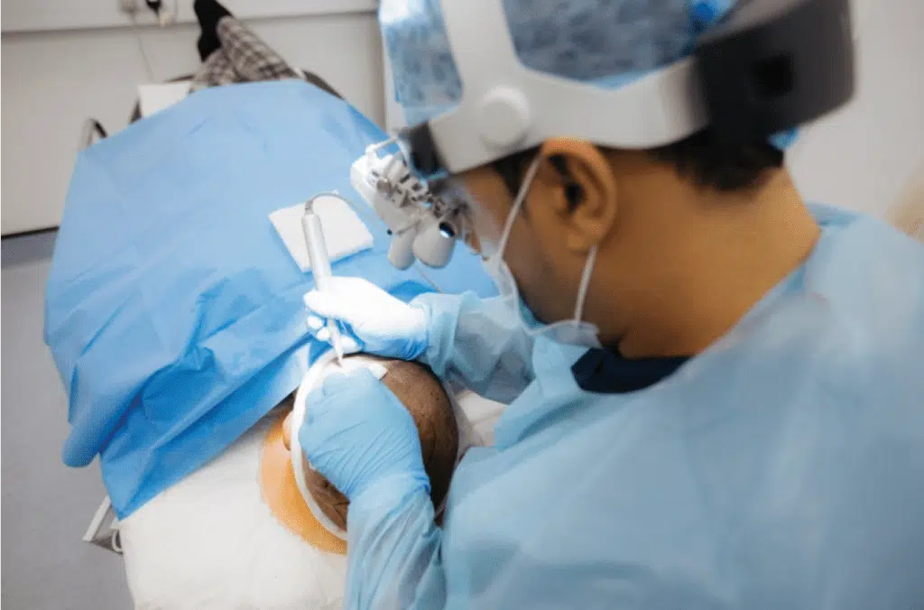 Eyebrow transplants for men