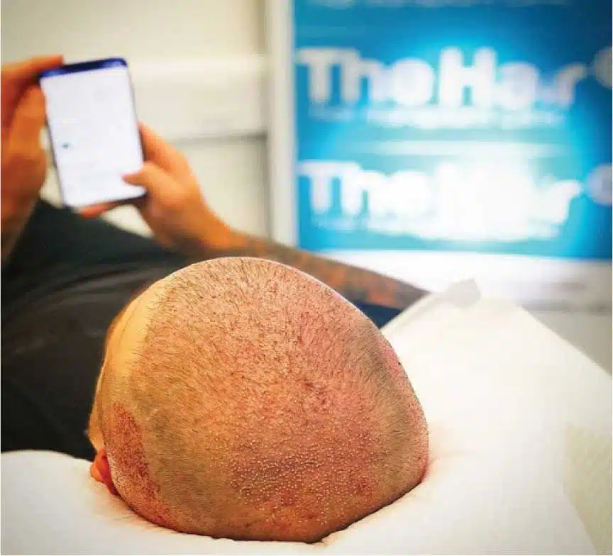 hair transplant procedure recovery