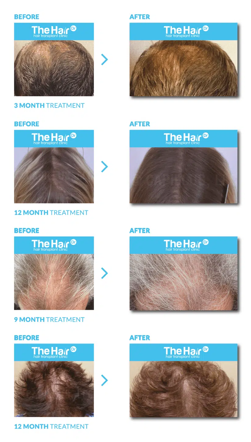 before and after hair treatment