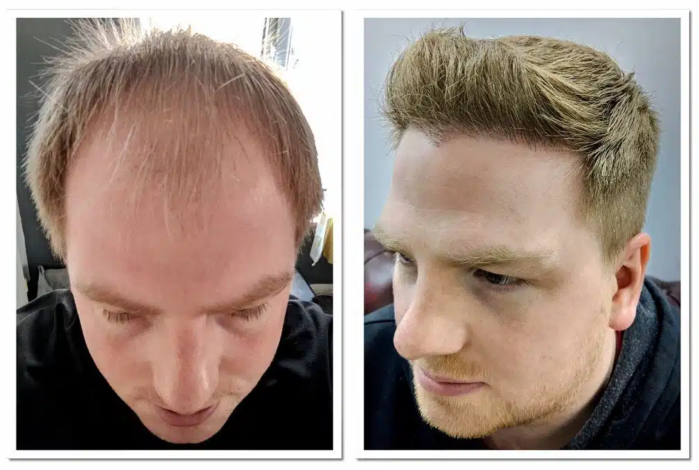 before and after hair transplant
