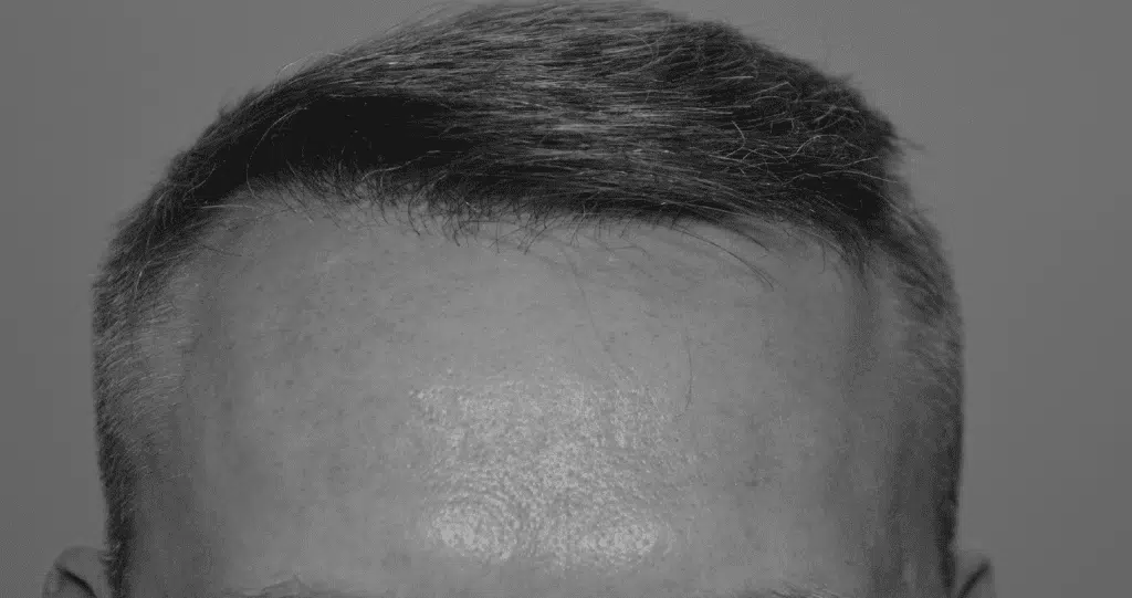 post modern hair transplant technique