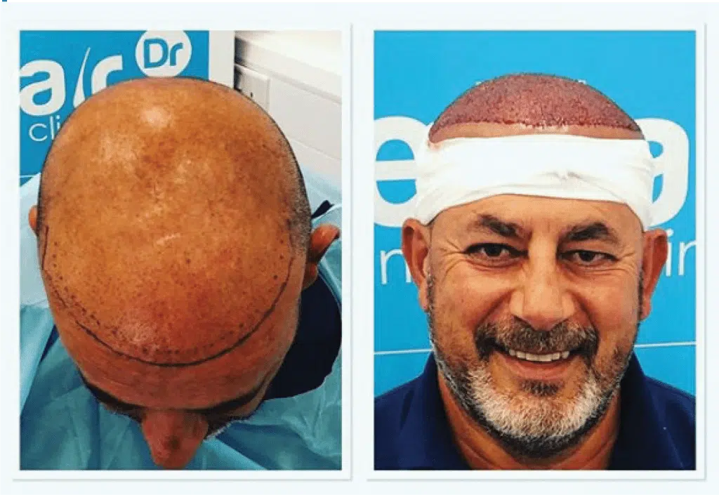 scabs after hair transplant