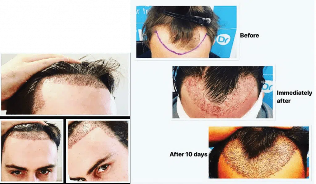 hair transplant healing time